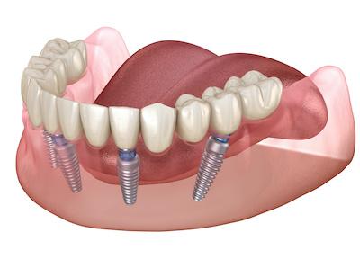 digital model showing implants in jaw