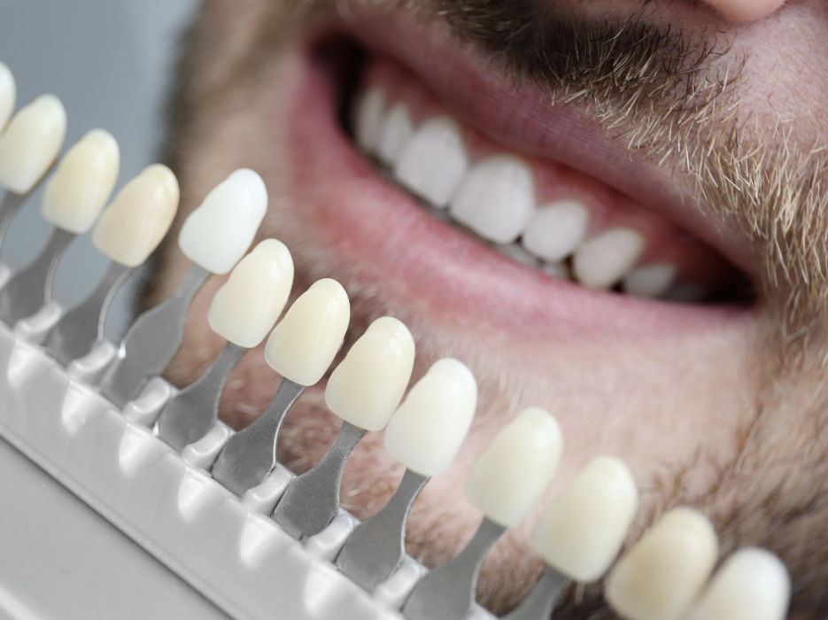 close up of man's smile getting teeth whitened