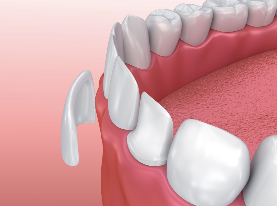 troy dental veneers