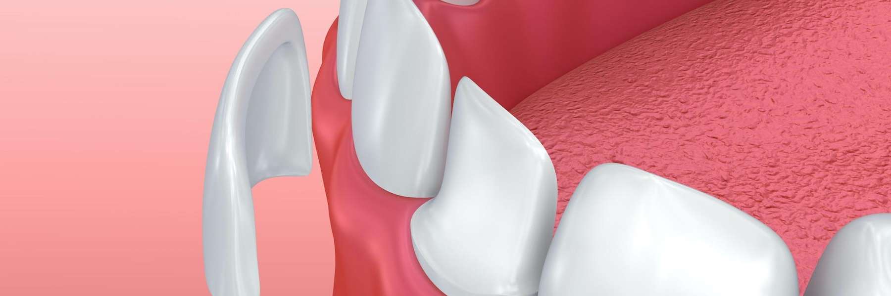 dental veneers