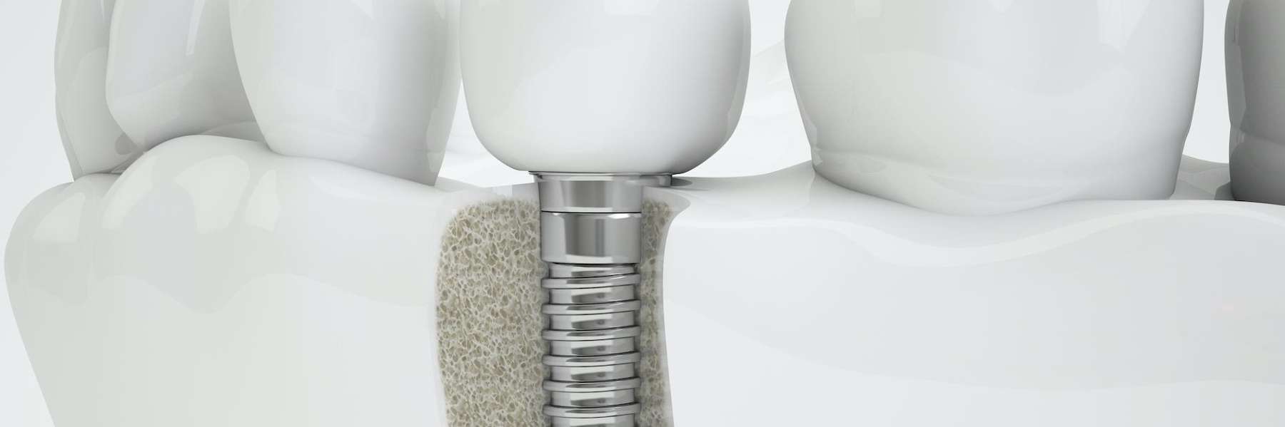 dental implant
