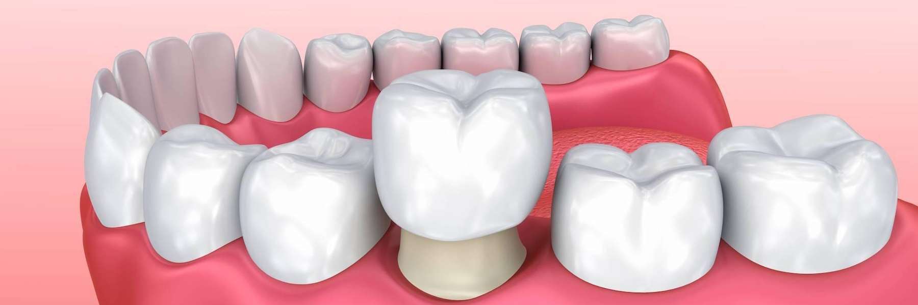 cerec same-day crown going over tooth